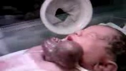 ولادة طفل بقلب ينبض خارج القفص الصدري(فيديو) ‎
